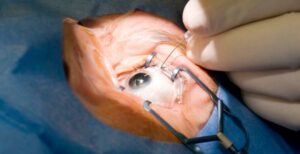Cataract Surgery